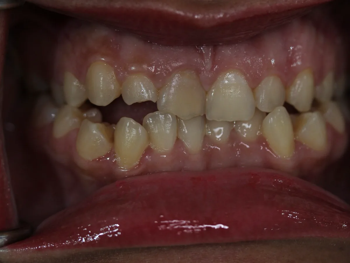 Before clear aligner treatment clinical image showing crowded front teeth
