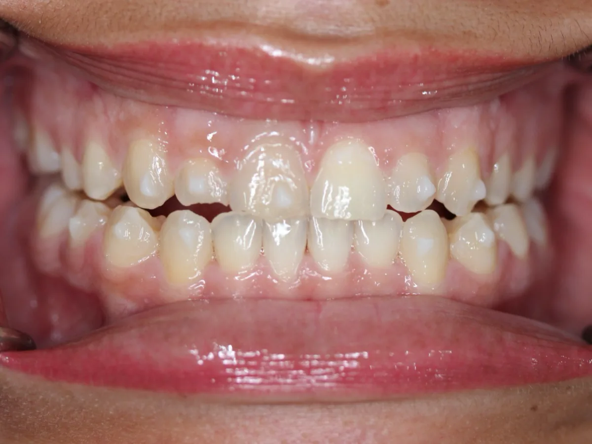After clear aligner treatment clinical image showing improved tooth alignment