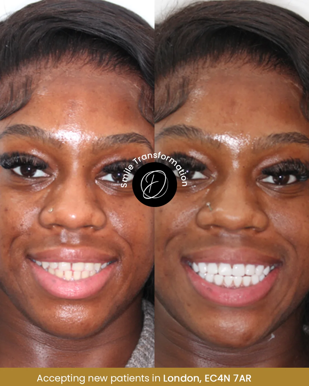 Composite bonding before and after smile example from Dr Ogo Eze Clinics