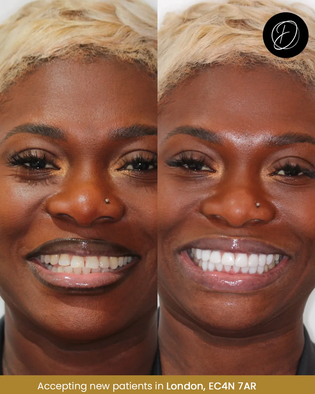 Composite bonding before and after smile example with brighter tooth shade