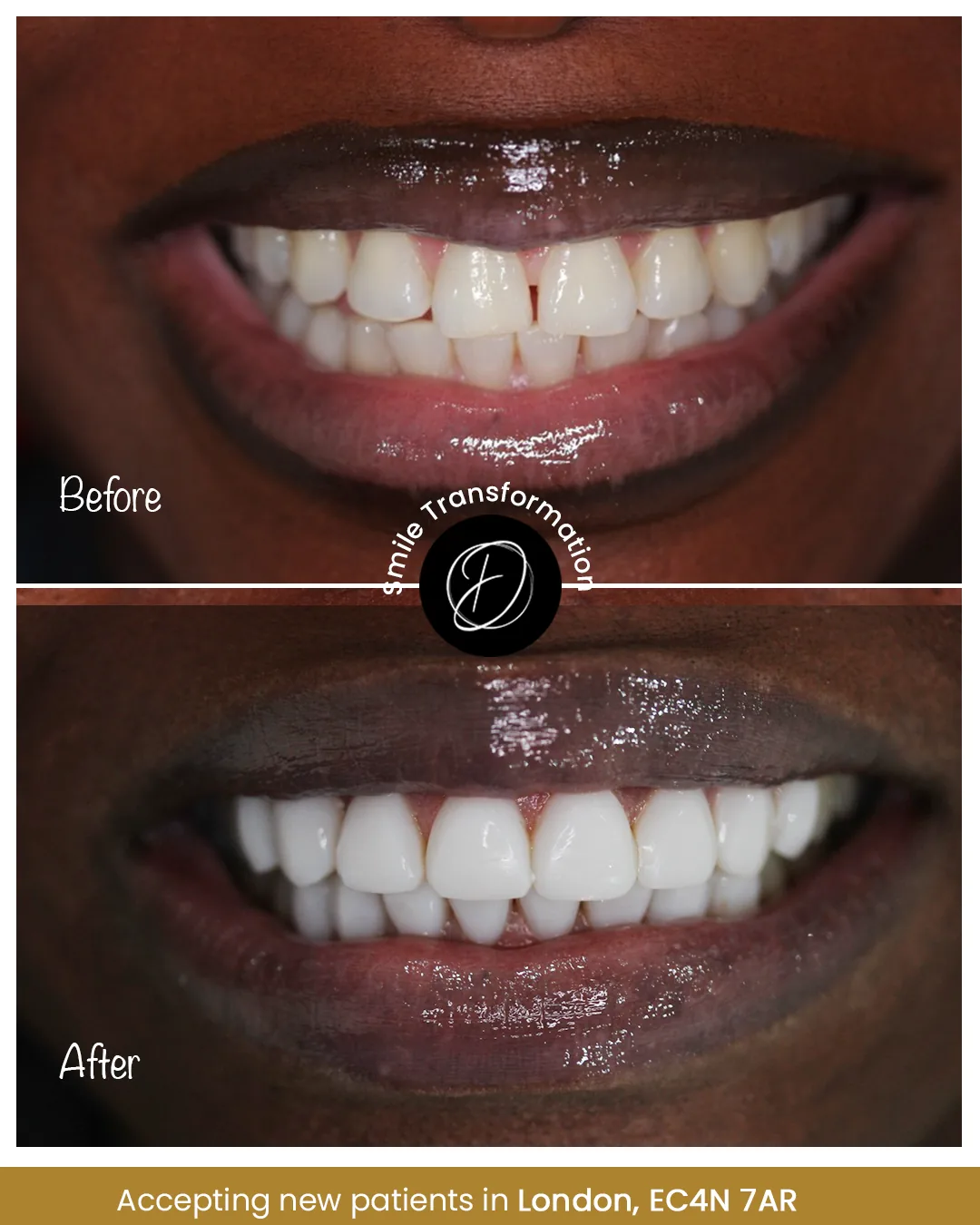 Close-up composite bonding before and after smile transformation