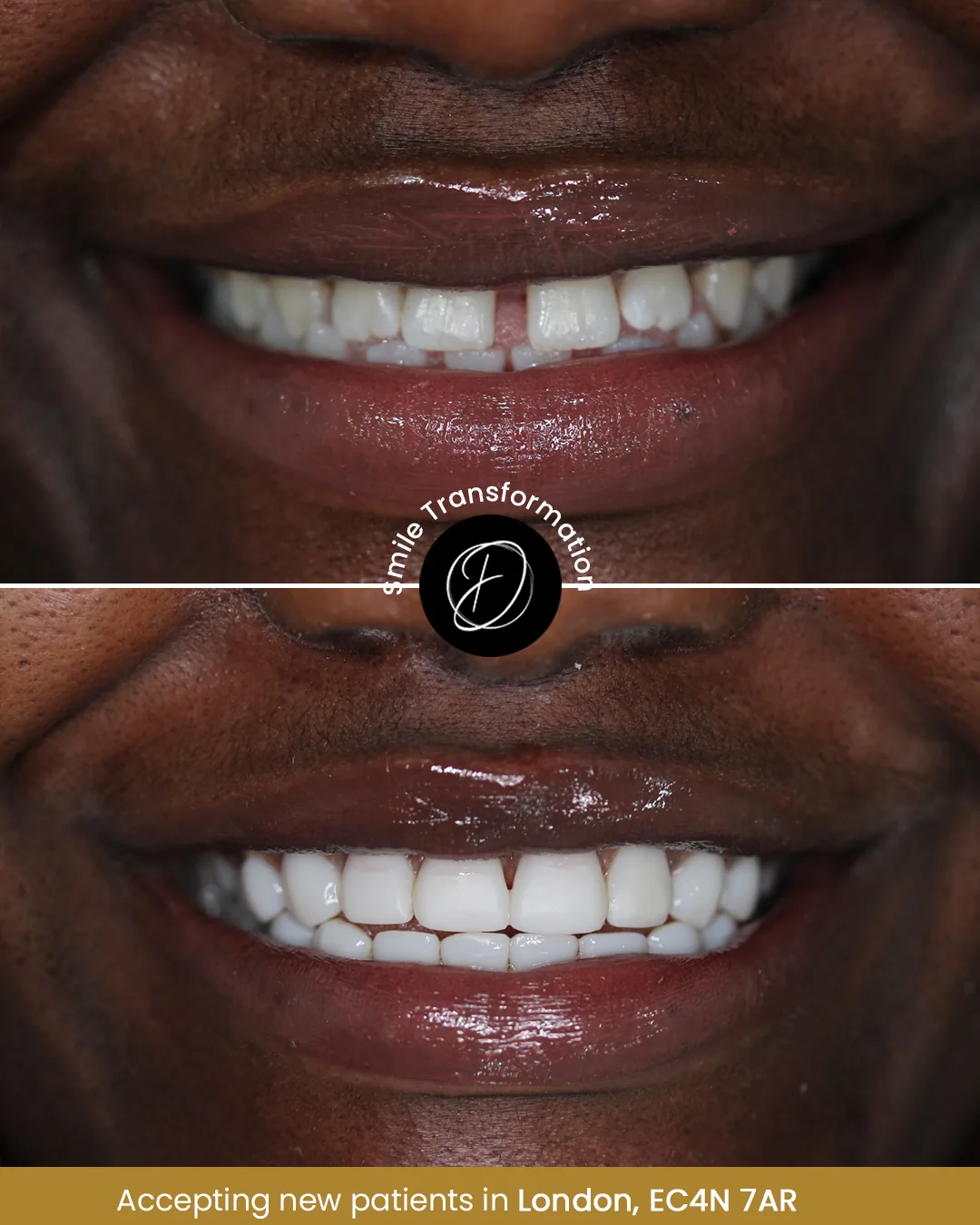 Close-up composite bonding before and after smile balance example