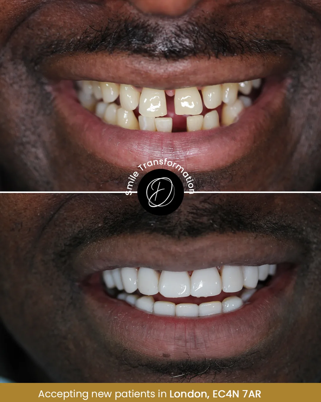 Composite bonding before and after smile example for a male patient