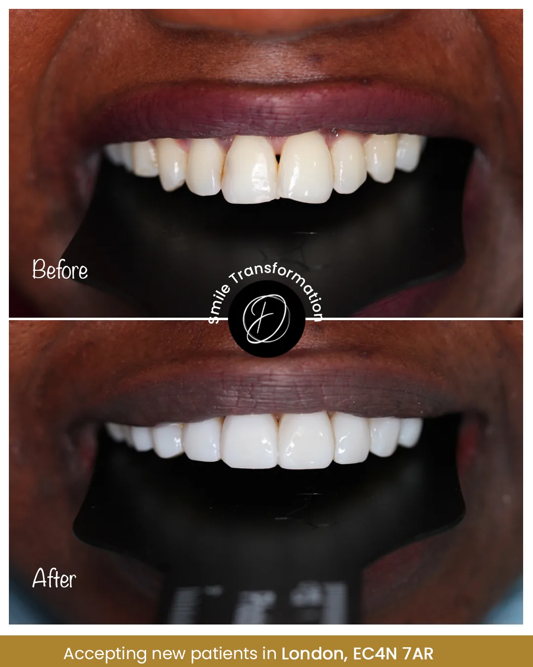 Veneer before and after smile example from Dr Ogo Eze Clinics