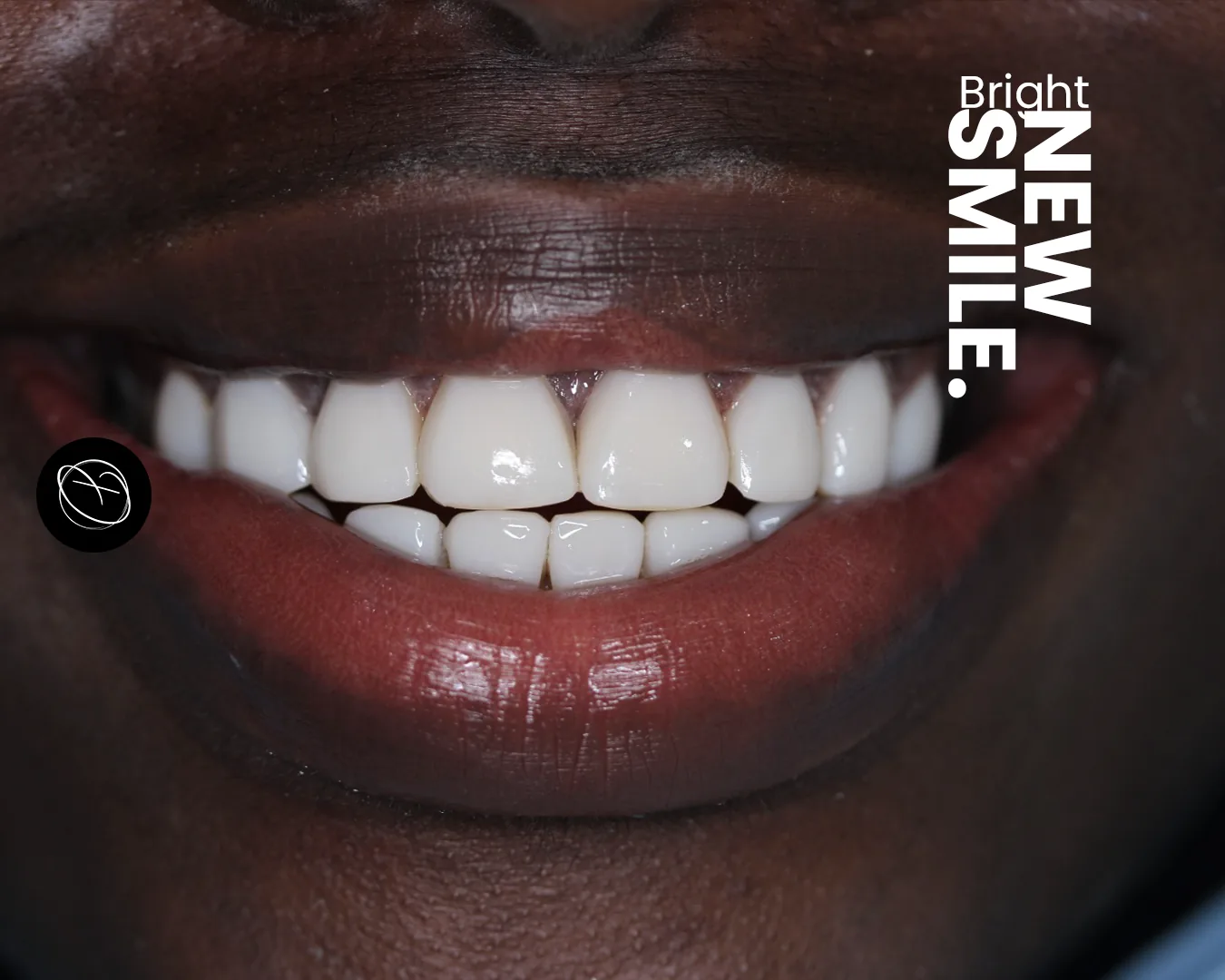 Veneer smile example with a bright natural-looking result
