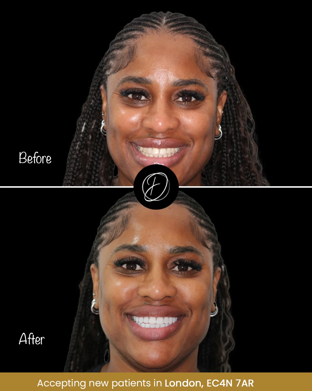 Veneer before and after smile transformation from Dr Ogo Eze Clinics