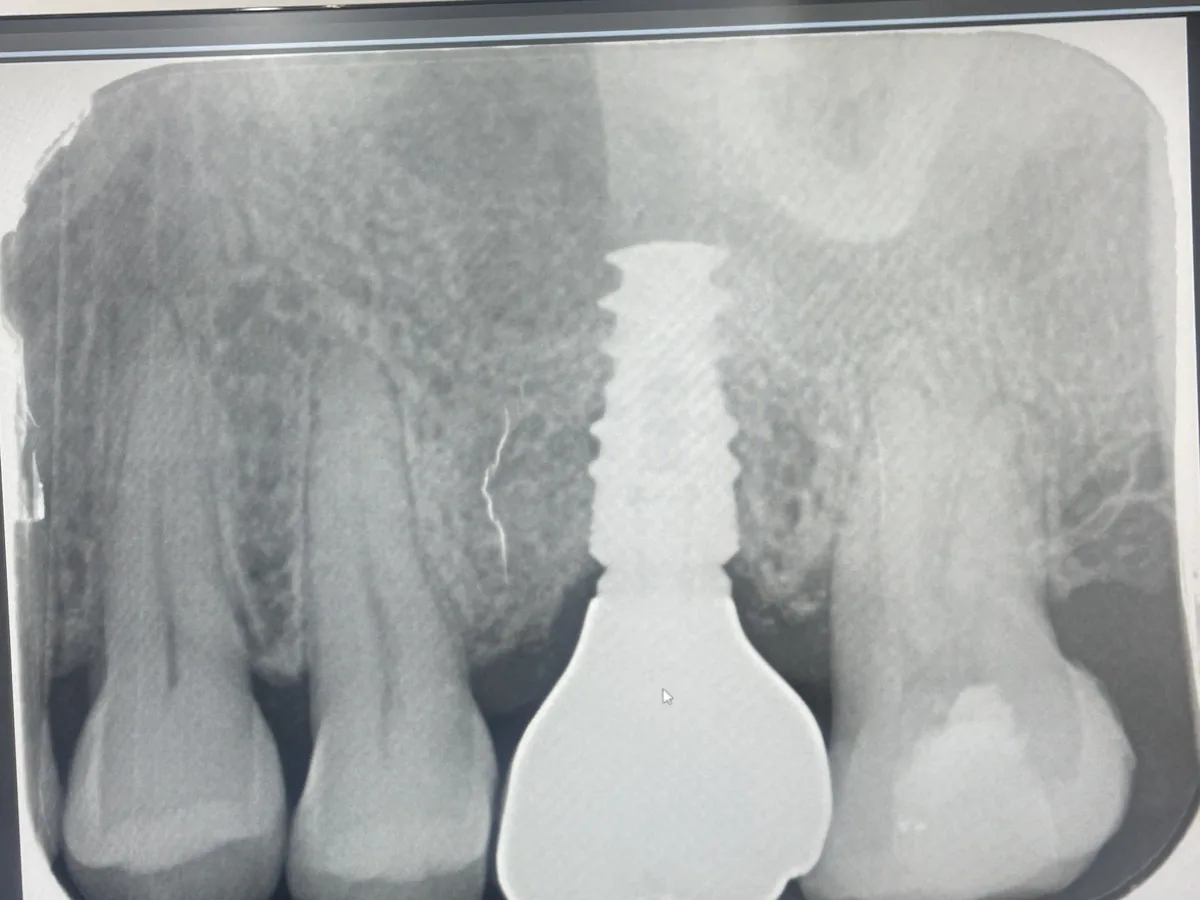 Dental X-ray showing implant planning for a missing upper left first molar