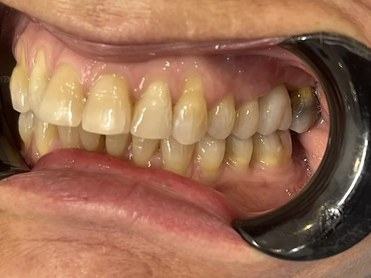 Clinical before photo showing the missing upper left first molar area