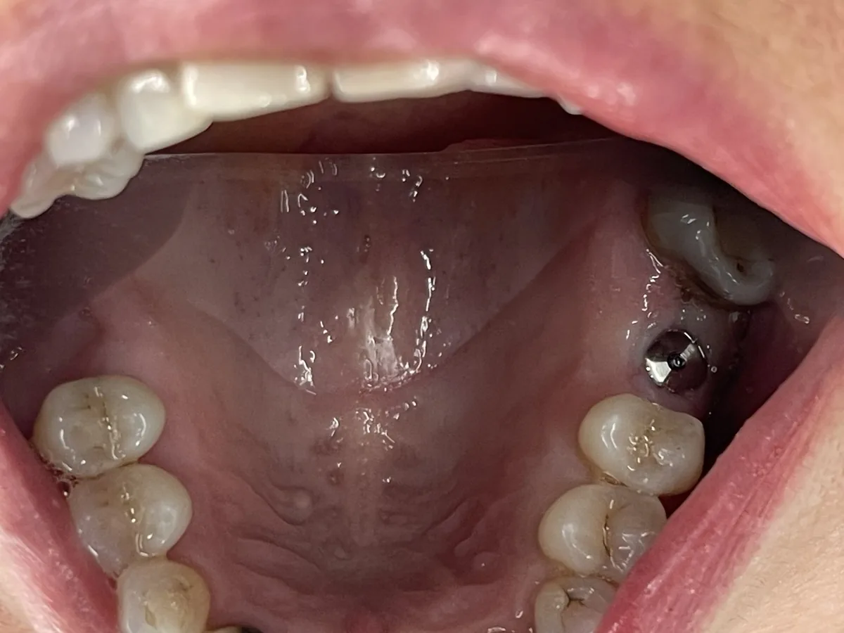 Clinical photo showing the implant stage for an upper molar replacement