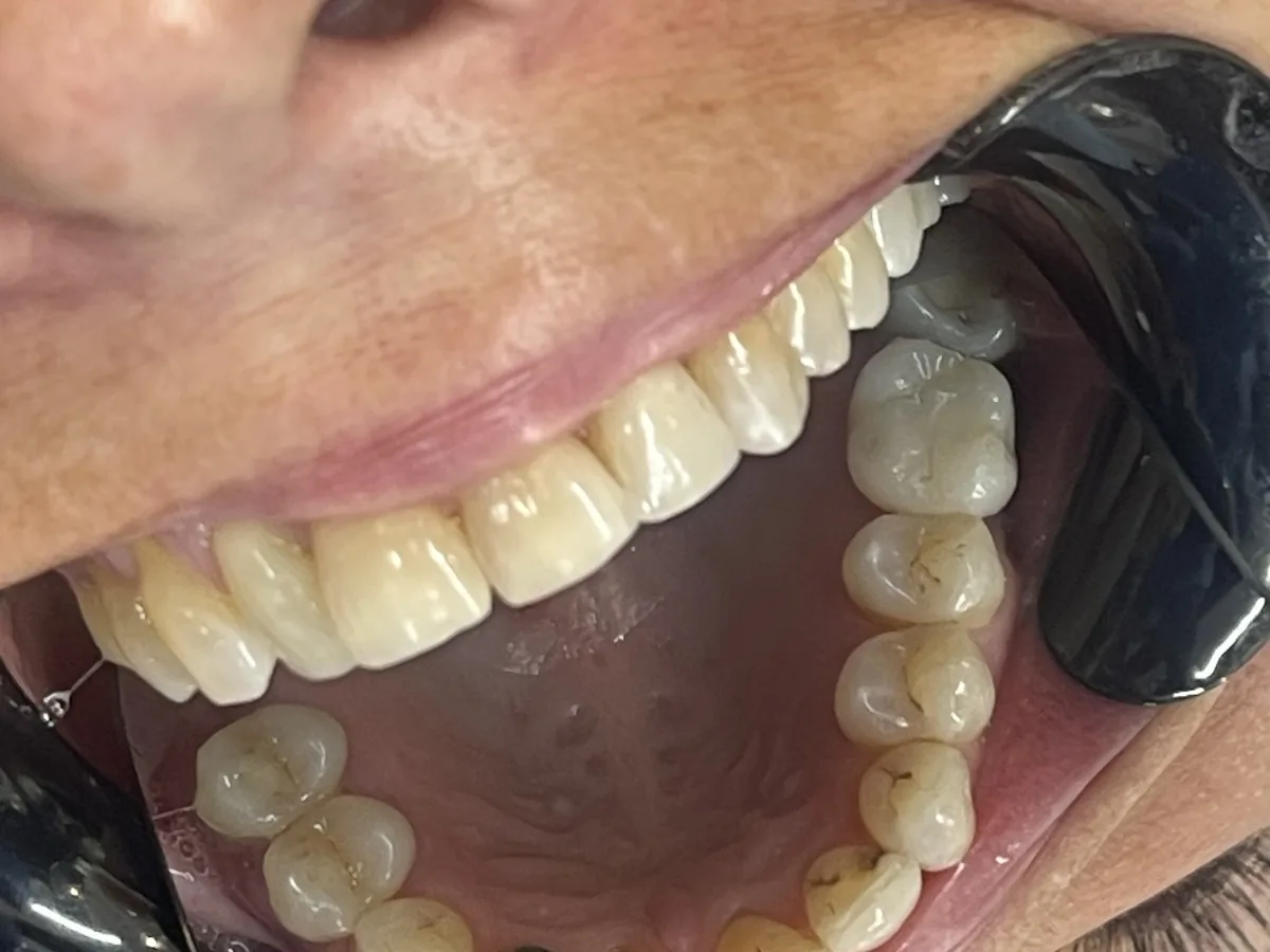 Clinical photo showing a final implant crown replacing an upper left first molar