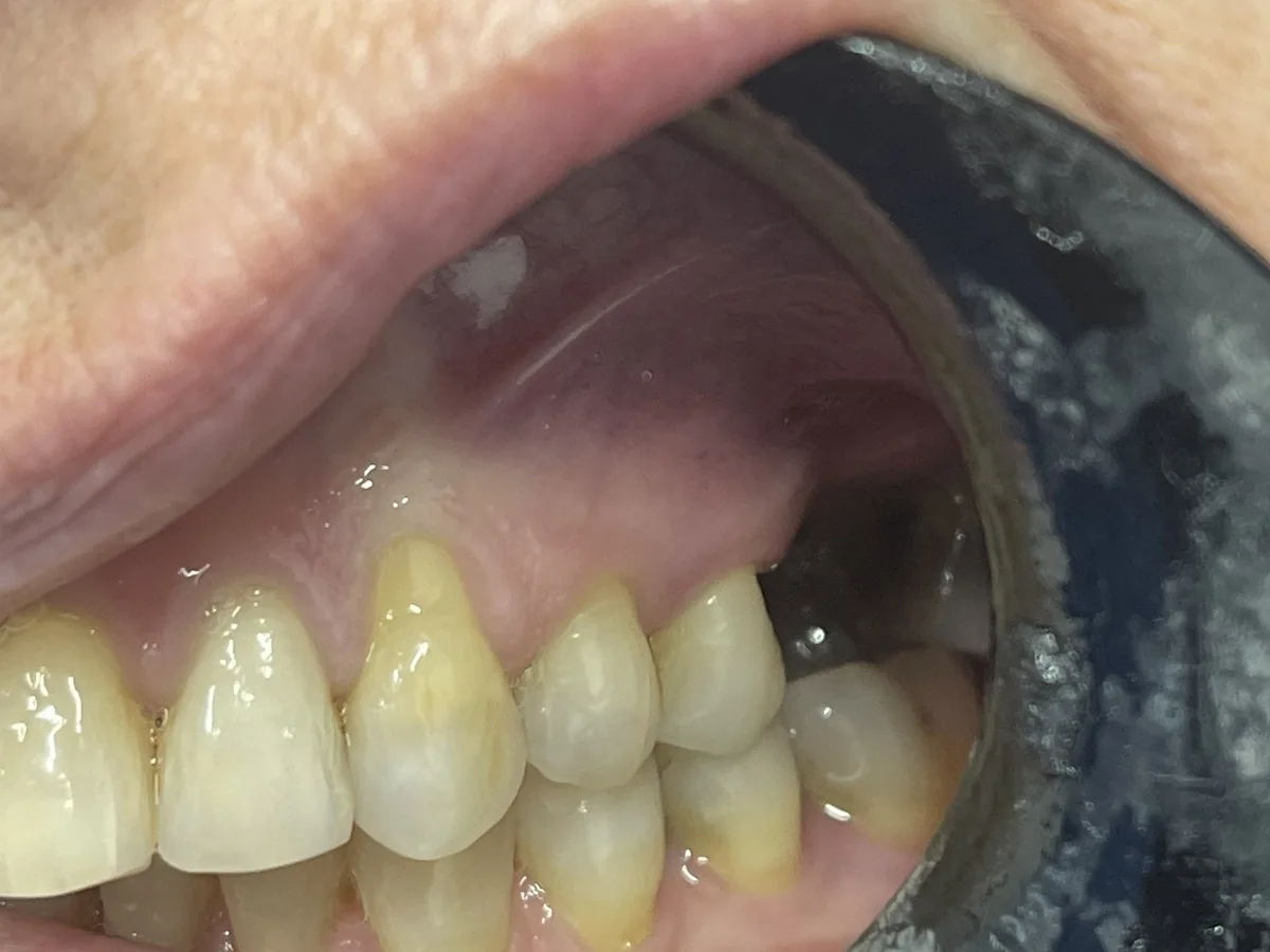 Clinical photo showing bite and fit review after implant crown placement