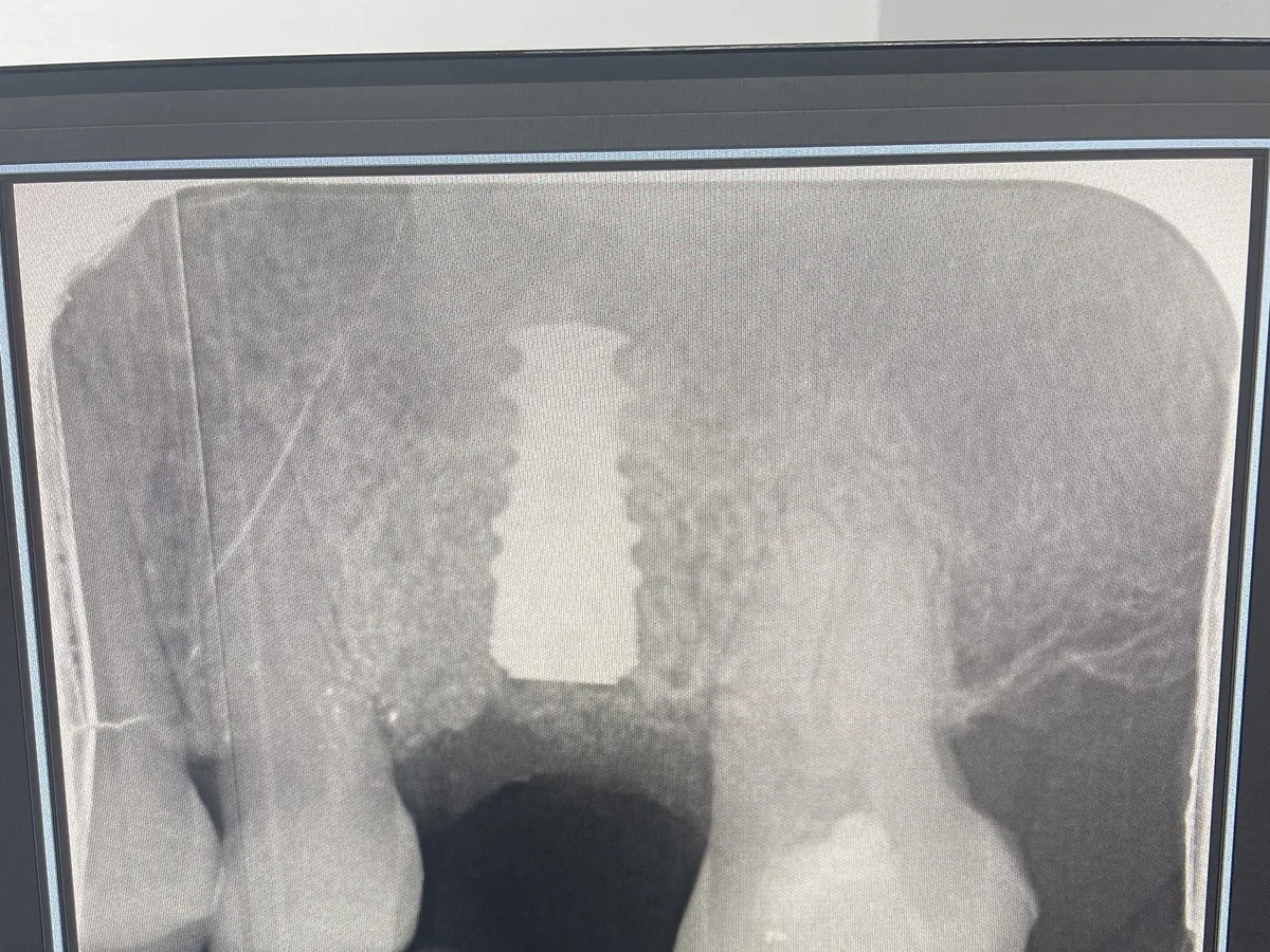 Final dental X-ray review for an upper left first molar implant crown