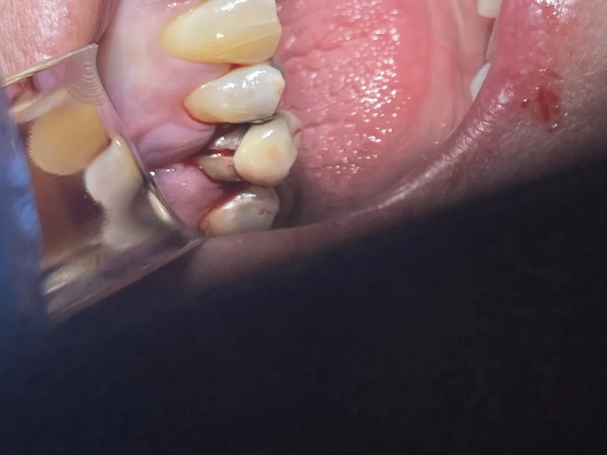 Clinical image showing a split root of an upper right 5 tooth before implant treatment