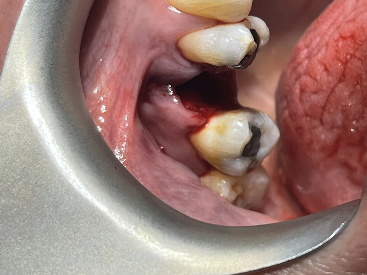 Clinical image after the upper right 5 tooth was extracted
