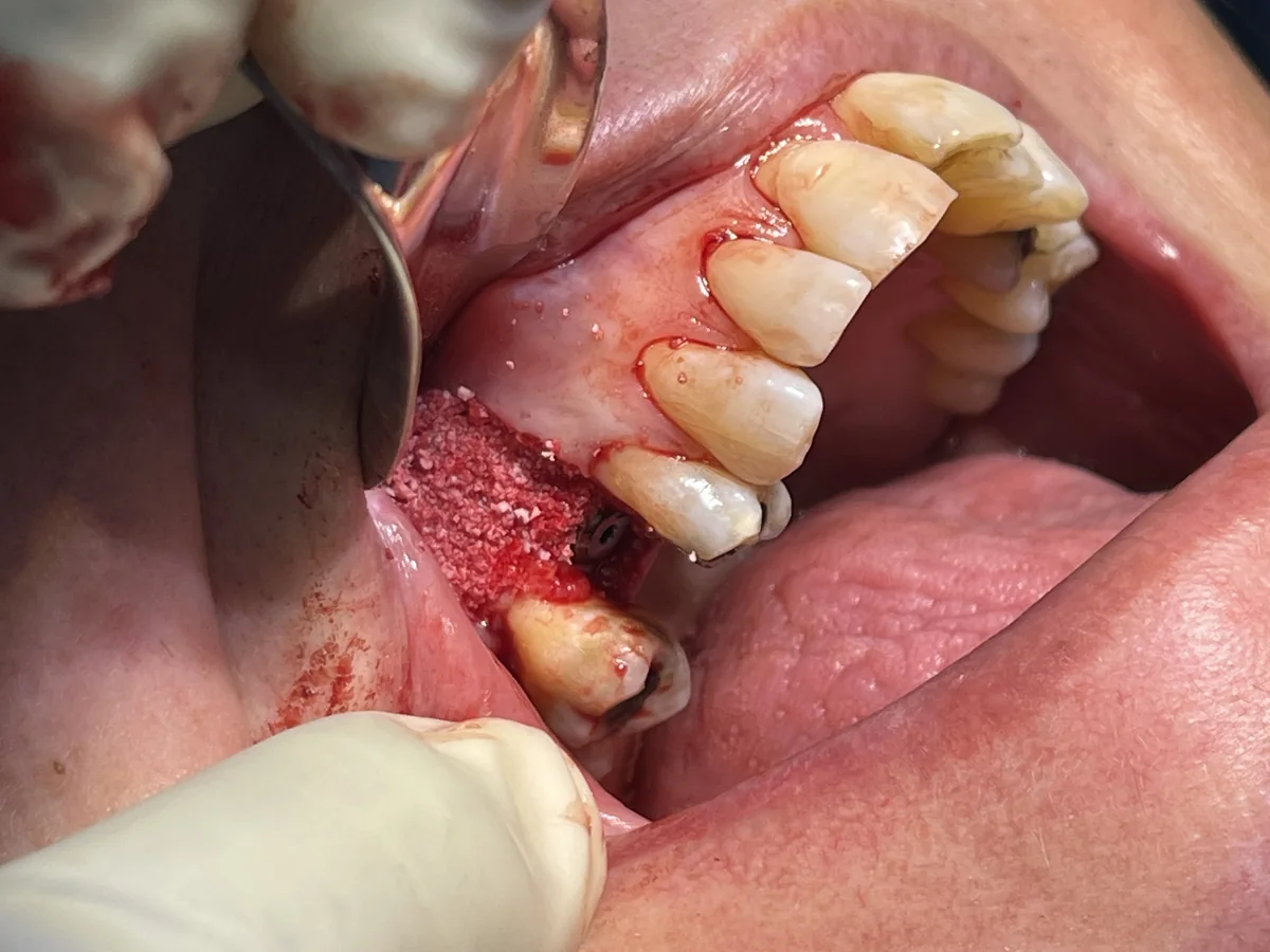 Clinical image showing implant screw placement with bone graft granules