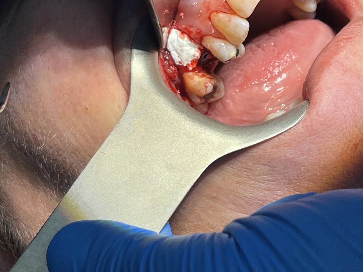Clinical image showing membrane placement over bone graft granules