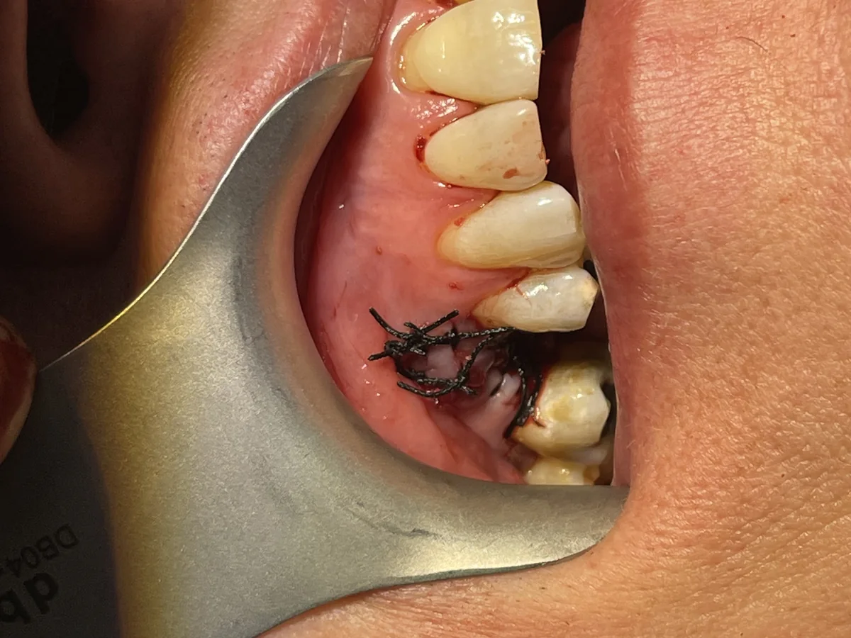 Clinical image showing gum flap replaced with stitches after implant placement