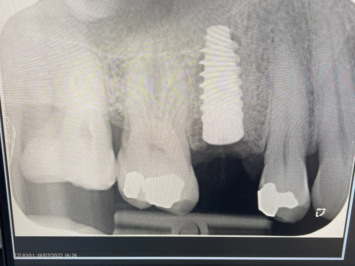 X-ray image showing the implant in place for the second implant example