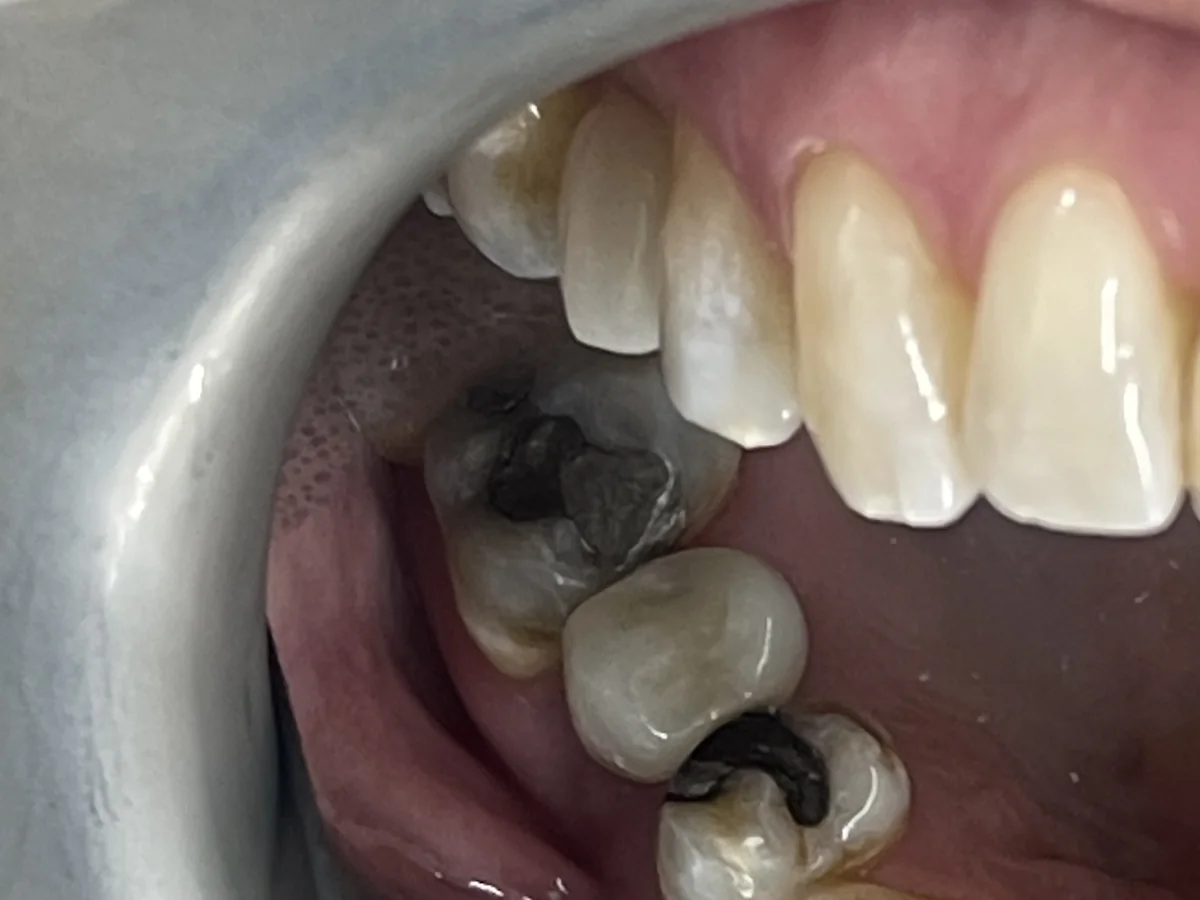 Clinical image showing implant crown fitted for the second implant example